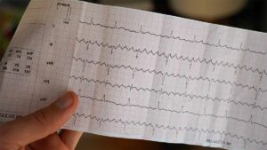 Algoritmo basato sull'intelligenza artificiale utilizzato per identificare il rischio di fibrillazione atriale molto prima
